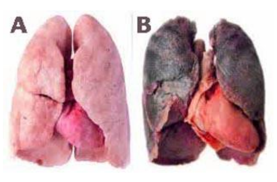 Gambar 13.  Paru-paru penderita kanker paru-paru