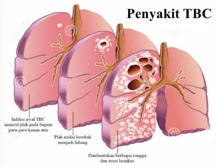 Gambar 12.  Paruparu penderita Tuberkulosis (TBC)